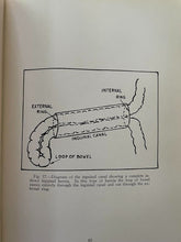 INJECTION TREATMENT OF HERNIA AND HYDROCELE - 1st 1938 - MEN'S MEDICINE HEALTH